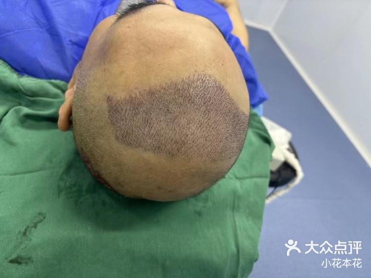 植发喝酒吸烟(植发喝酒会影响存活吗)