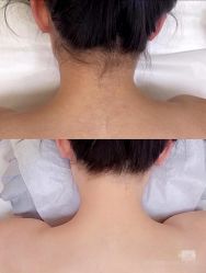 -薇兰专业脱毛连锁机构