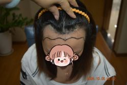 体验前-大麦微针植发全国连锁