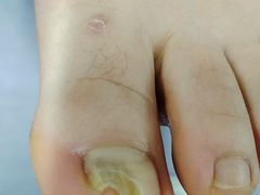 -祖传修脚甲沟炎灰指甲鸡眼