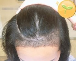 -大麦微针植发丨全国连锁