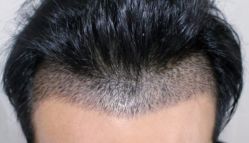 -大麦微针植发全国连锁