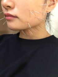 -肥三针腧穴瘦身馆