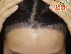 -大麦微针植发全国连锁