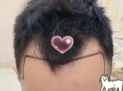 -大麦微针植发全国连锁