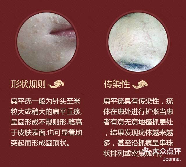 2021年9月10日 关注 看到扁平疣不要乱碰哦 本病是由人乳头状瘤病毒