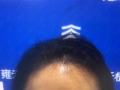 体验后-雍禾植发全国连锁