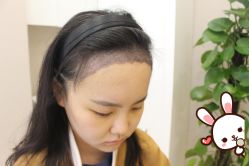 -大麦微针植发丨全国连锁