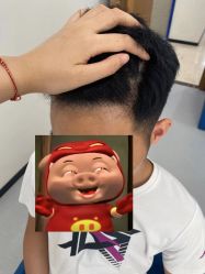 -大麦微针植发全国连锁