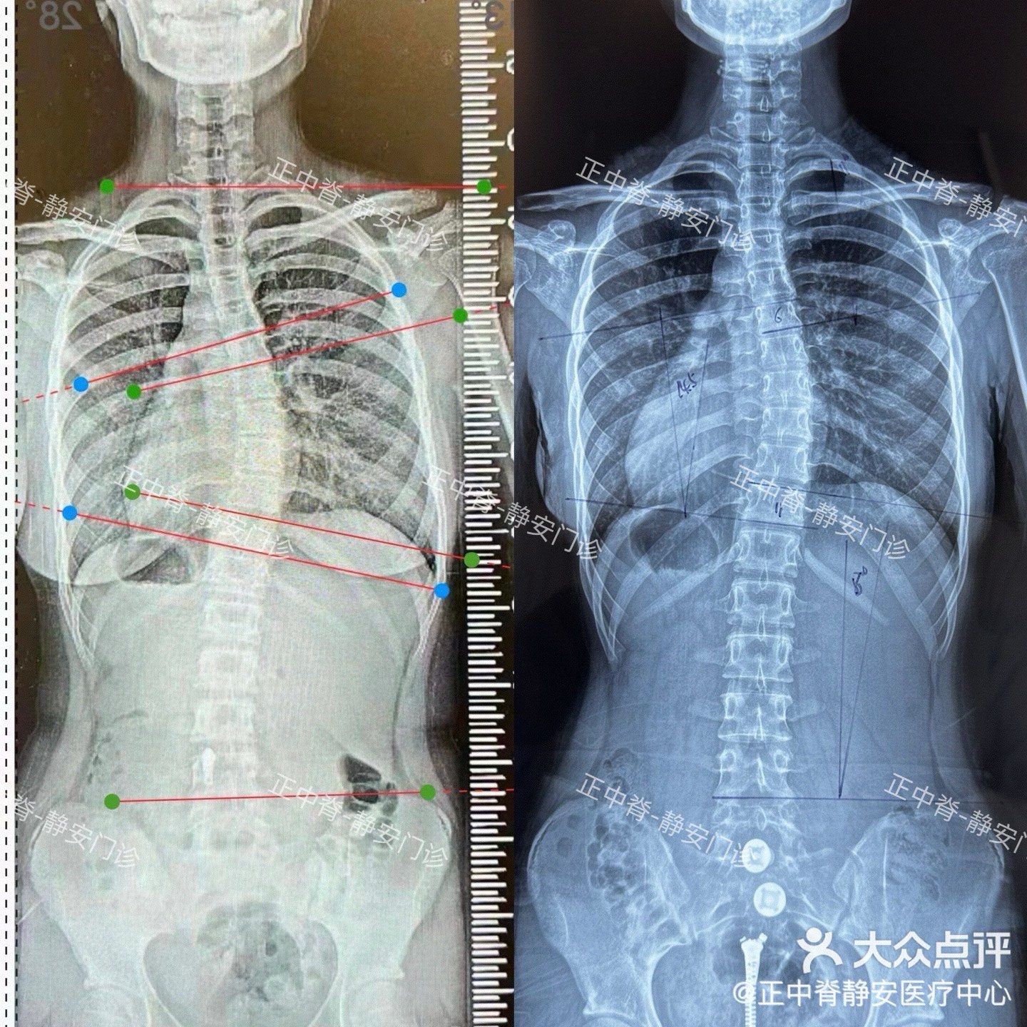 脊柱后凸度数对照表图片