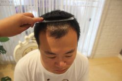 点击看大图 -大麦微针植发丨全国连锁