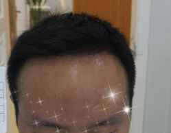 -大麦微针植发全国连锁