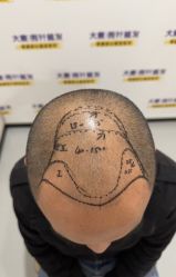 -大麦微针植发全国连锁