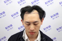 -大麦微针植发丨全国连锁