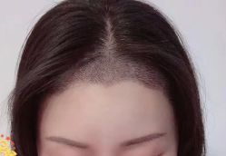 -大麦微针植发丨全国连锁