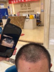 -碧莲盛·不剃发植发