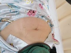 -杭州仁易堂中医康复医院疤痕修复
