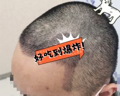 -大麦微针植发全国连锁