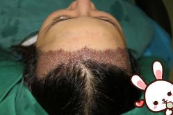 点击看大图 -大麦微针植发丨全国连锁