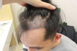 点击看大图 -大麦微针植发丨全国连锁