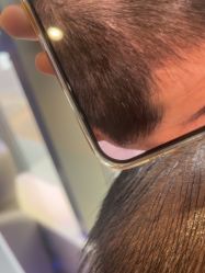 -碧莲盛·不剃发植发