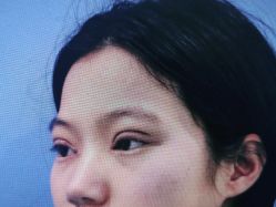 体验后-西安壹加壹医疗美容·西北抗衰旗舰店