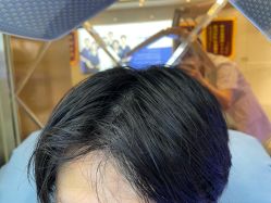 点击看大图 -碧莲盛·不剃发植发