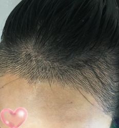 -大麦微针植发丨全国连锁