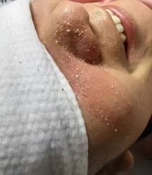 -苗方清颜专业祛痘连锁机构