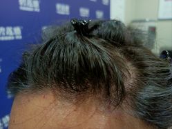 -碧莲盛·不剃发植发