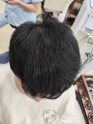 -大麦微针植发全国连锁