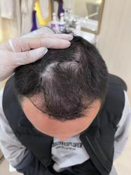 点击看大图 -碧莲盛·不剃发植发
