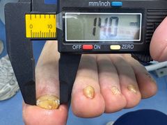 -Andrew指甲专科灰指甲·甲沟炎矫正·3D步态矫形鞋垫定制(浦三路店)