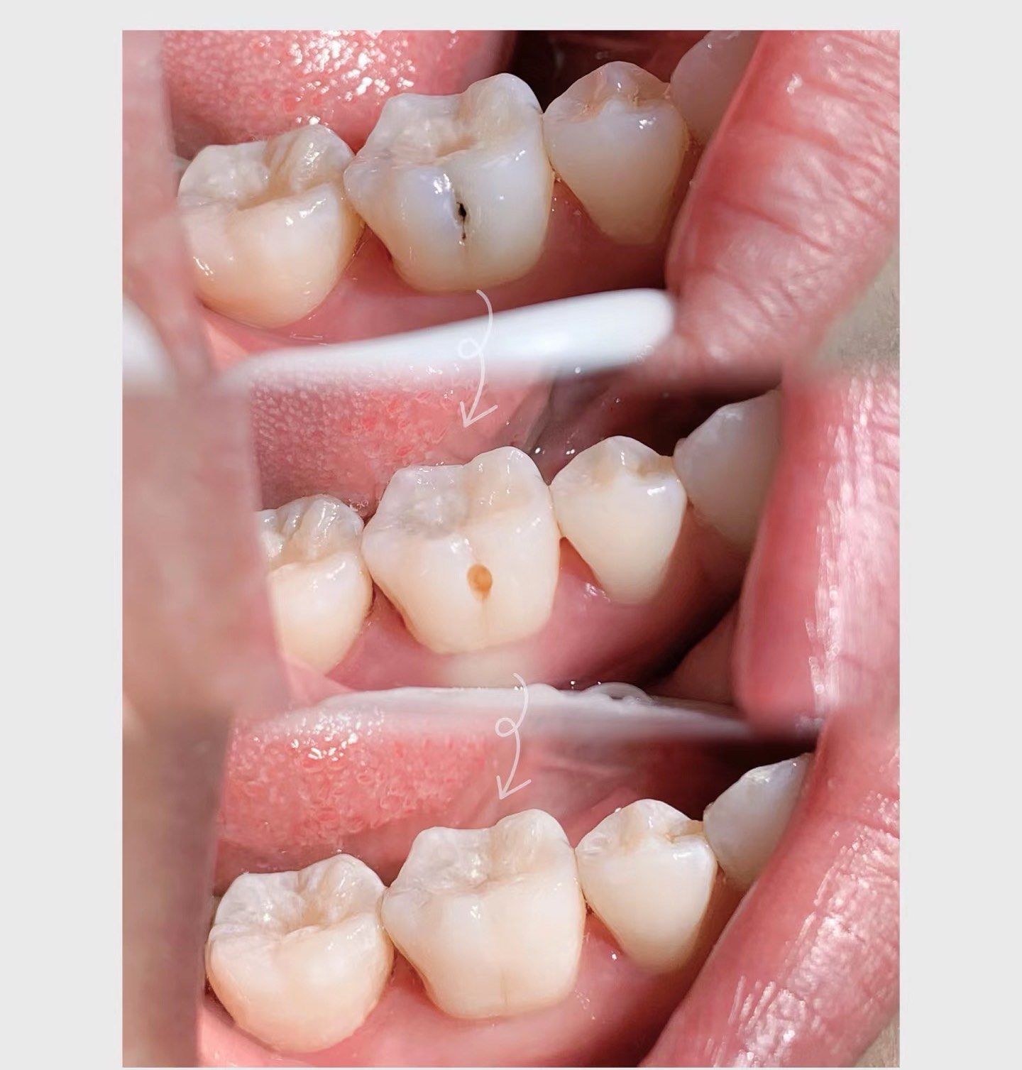 有蛀牙大家真的要早一点