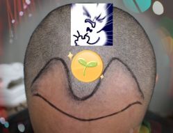 -大麦微针植发全国连锁