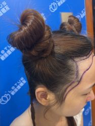 -碧莲盛·不剃发植发