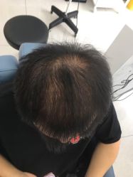 体验前-大麦微针植发丨全国连锁