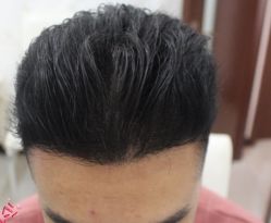 -大麦微针植发丨全国连锁