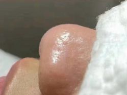 -成都苗方清颜专业祛痘