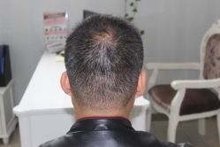 -大麦微针植发丨全国连锁