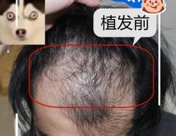 -大麦微针植发全国连锁