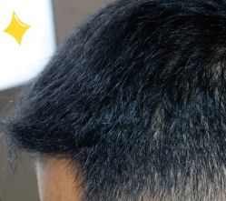 -大麦微针植发丨全国连锁