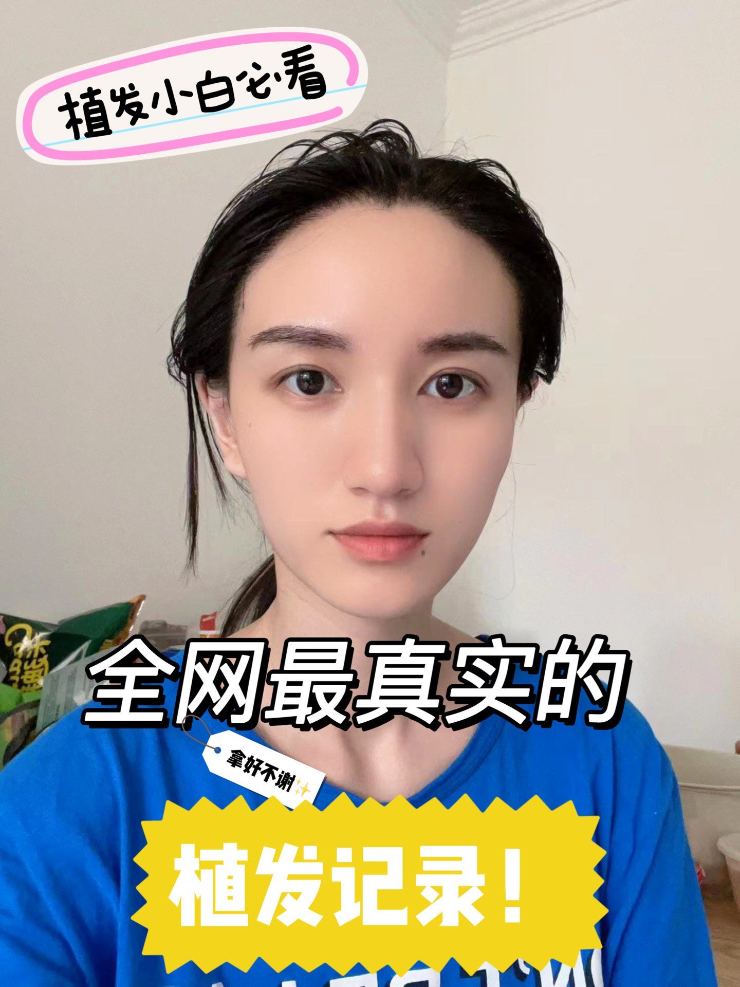 爱美的人植发(植发可以植美人尖吗)