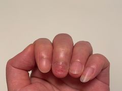 -Andrew指甲专科灰指甲·甲沟炎矫正·3D步态矫形鞋垫定制(浦三路店)