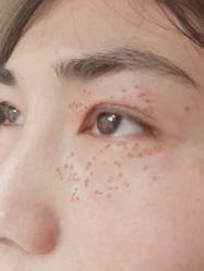 -美丽人生祛斑扁平疣汗管瘤中心