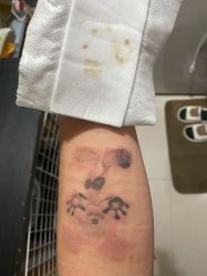-一次性洗纹身·修复疤痕·超皮秒