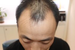 -大麦微针植发丨全国连锁