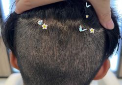 -大麦微针植发全国连锁