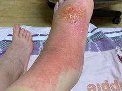 -大韩庄韩氏祖传正骨