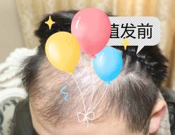 -大麦微针植发全国连锁